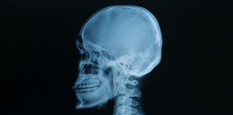 Komplettes Gesicht mit 3-D-Drucker rekonstruiert