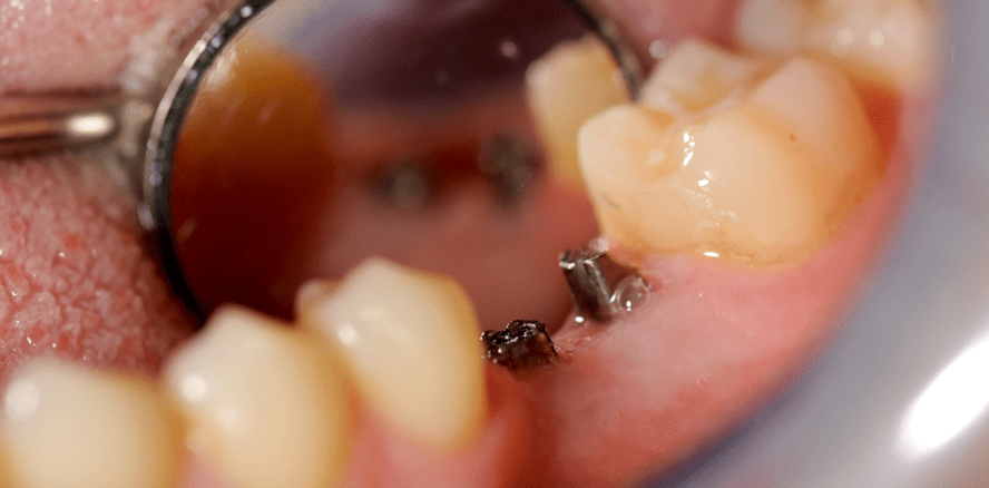 Versorgung einer Schaltlücke mit einteiligen Implantaten