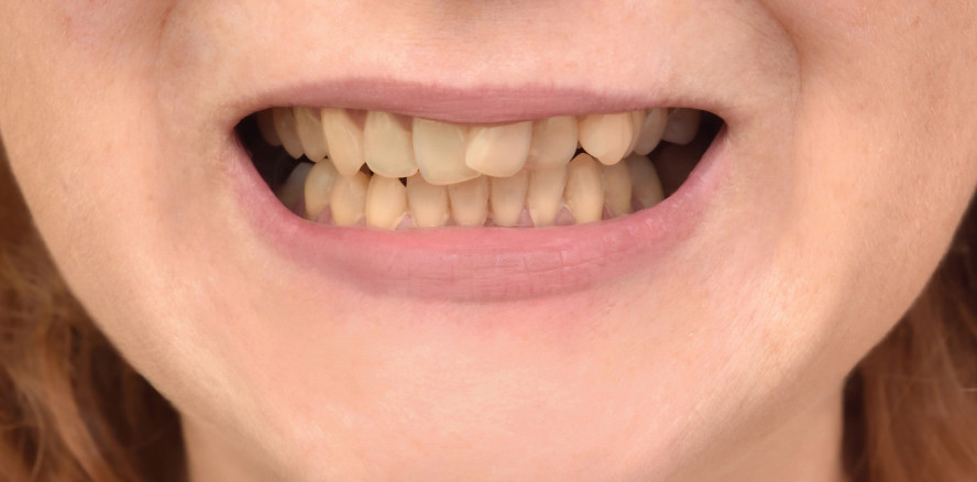 Perfekte Zähne sind out – jetzt kommt schief und gelb!