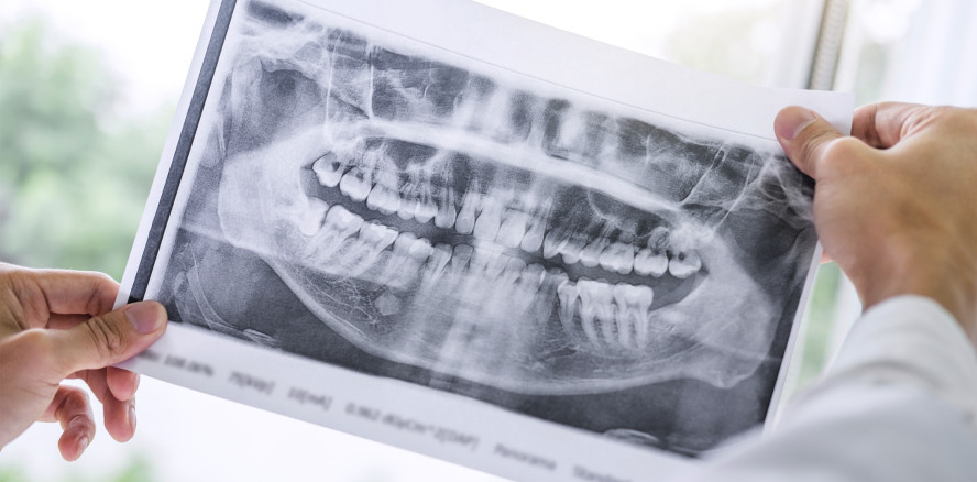Schneider'sche Membran: Einflussfaktoren untersucht