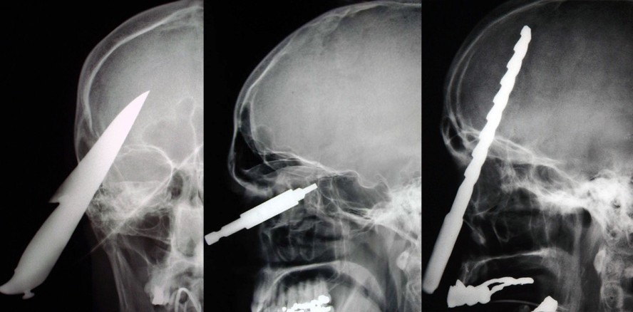 Skurrile Verletzungen: Messer und andere Gegenstände im Kopf