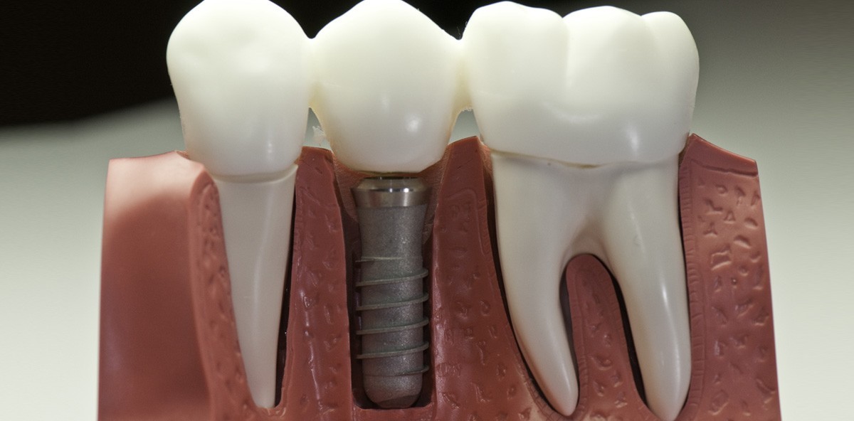 Speichelpeptide verbessern die Osseointegration von Implantaten