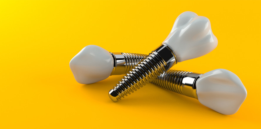 Über 20 Jahre Beobachtungen an 10.000 Implantaten