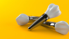 Über 20 Jahre Beobachtungen an 10.000 Implantaten