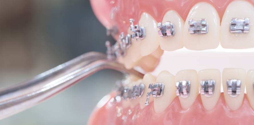 Neue Studie: KFO-Behandlungen wieder unter Beschuss