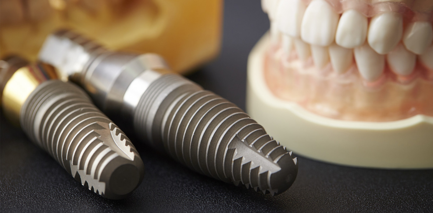 Misserfolge in der dentalen Implantologie – was sind die Gründe?