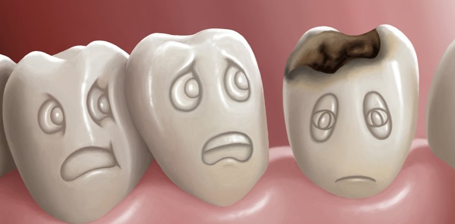 15 Prozent der Kleinkinder sind von Karies betroffen