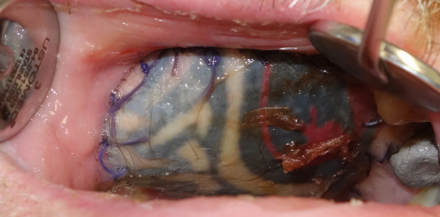 Defektdeckung: Tattoos als Herausforderung für Behandler