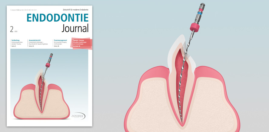 Aktuelles Endodontie Journal: Zahnerhaltung in komplexen Fällen