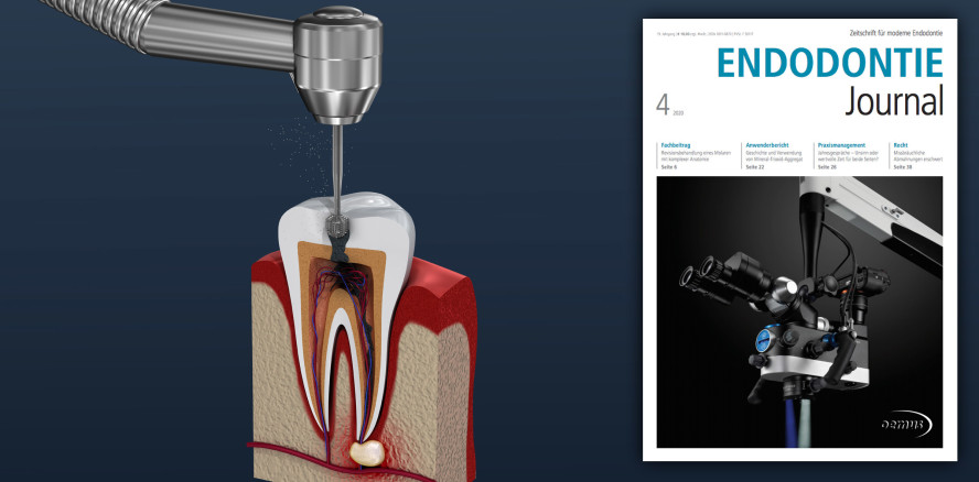 Endodontie Journal: Von Wurzelkanalaufbereitung bis Revision