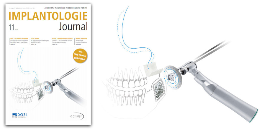 Aktuelles Implantologie Journal jetzt online lesen