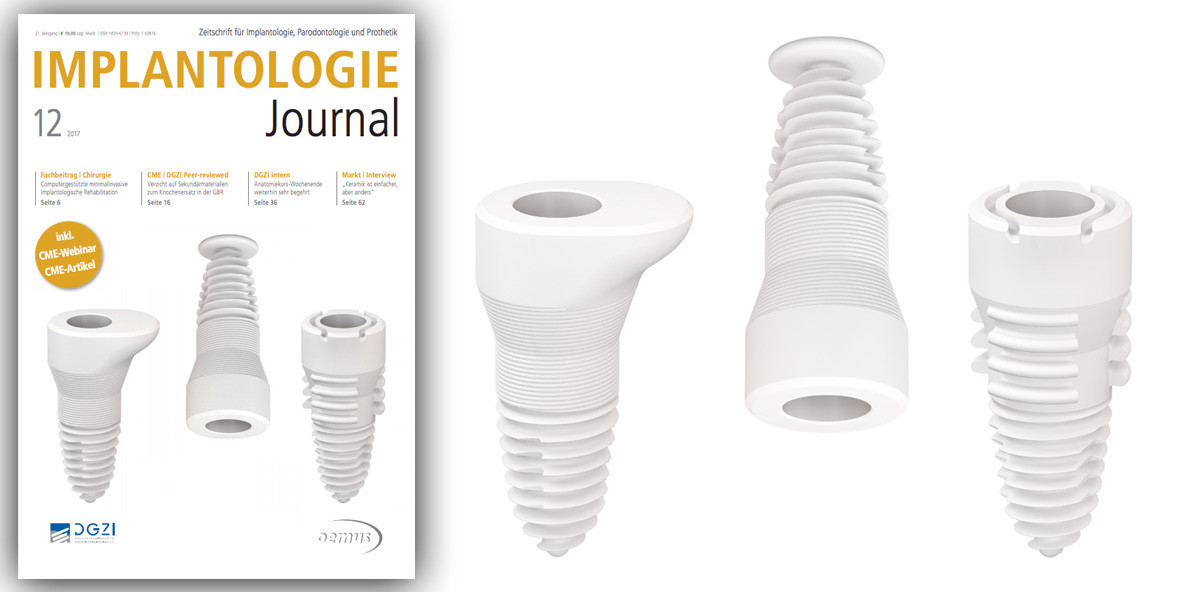 Digitale Implantologie im Fokus des aktuellen Implantologie Journal