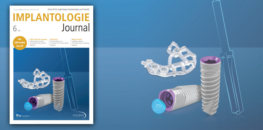 Juni-Ausgabe des Implantologie Journal: Update GBR und GTR
