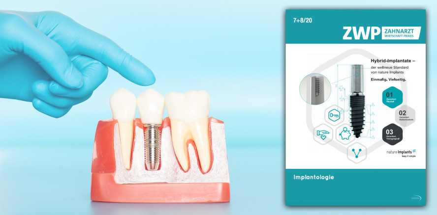 ZWP spezial ist online: Was reizt Sie an der Implantologie?