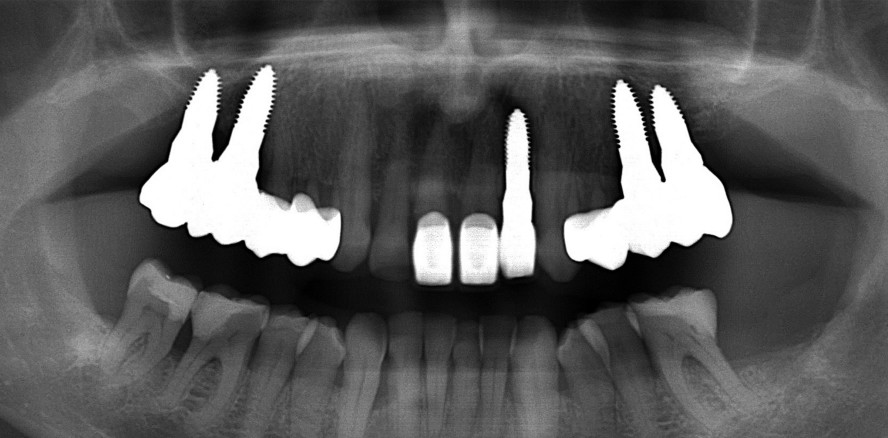 Unterstützung der ­Osseo­integration von Keramik­implantaten