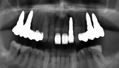 Unterstützung der ­Osseo­integration von Keramik­implantaten