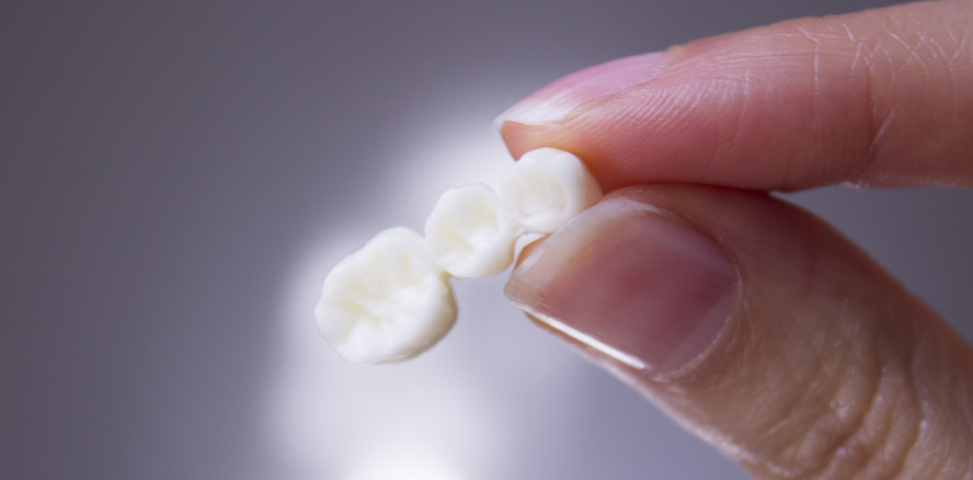 Update der Leitlinie „Vollkeramische Kronen und Brücken“ veröffentlicht