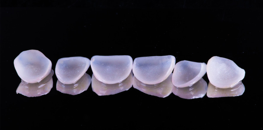 Viraler Hit: Zahnarzt testet selbstklebende Veneers von Amazon