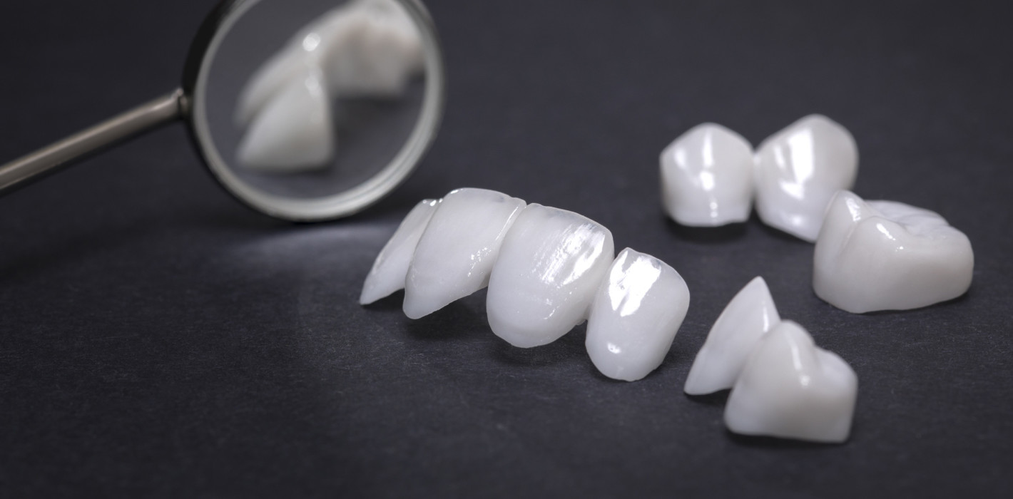 Veneers und Begleitleistungen richtig abrechnen