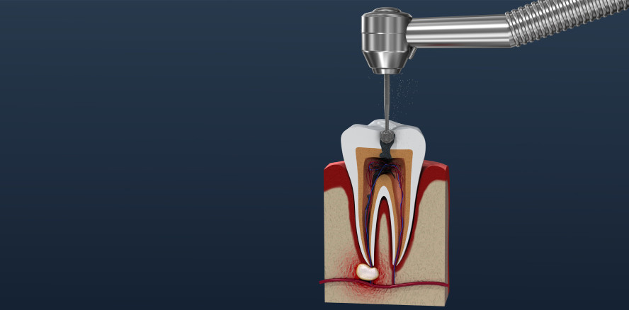 Wurzelkanalbehandlung: Vitale Zähne dank Hydrogel