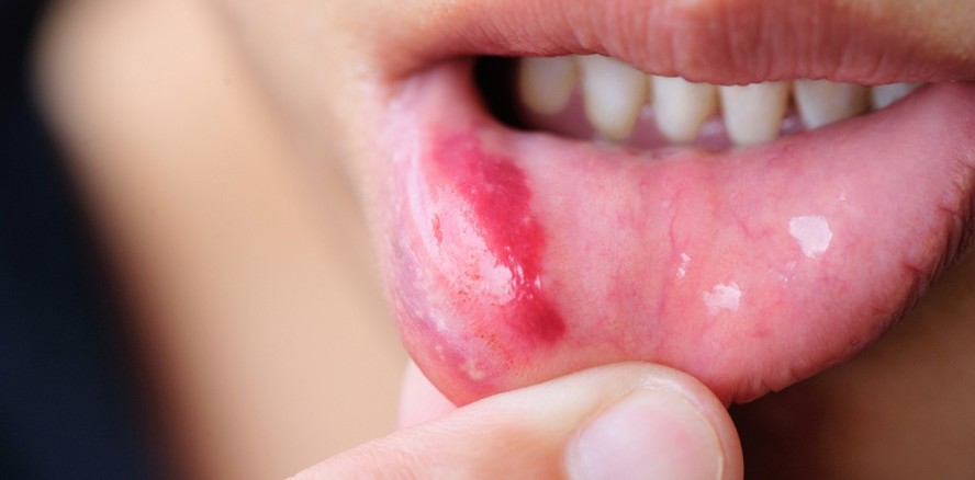 Speichel als Booster: Warum Wunden im Mund schneller heilen