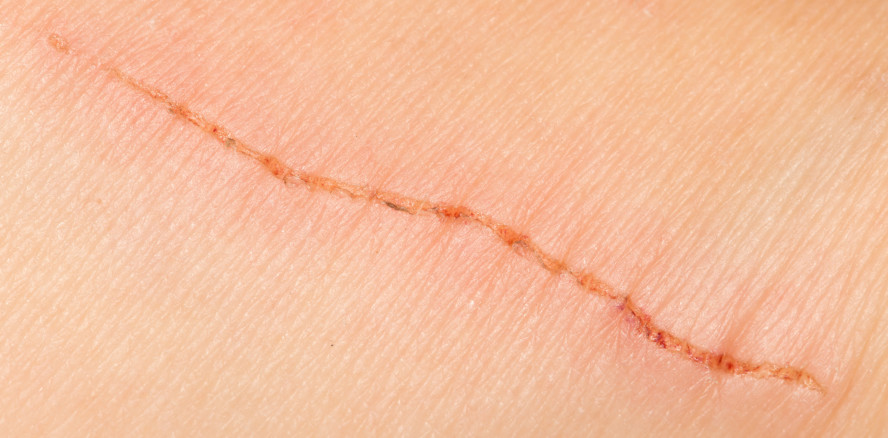 Wundheilung: Gliazellen fördern die Regeneration der Haut