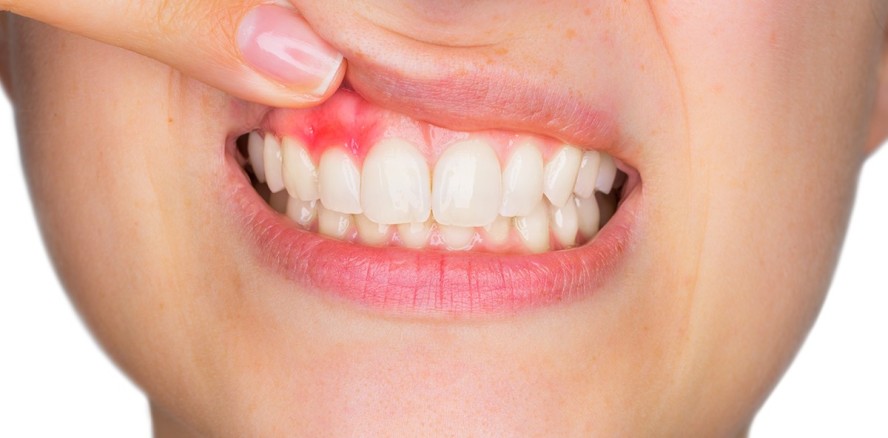 Infektion und Behandlung der Zahnwurzelspitze