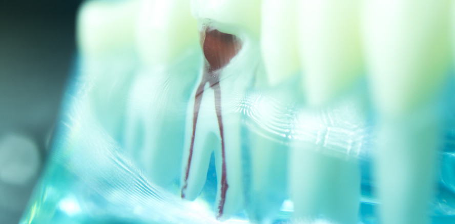 Studie belegt: Wurzelbehandlung ist besser als ihr Ruf