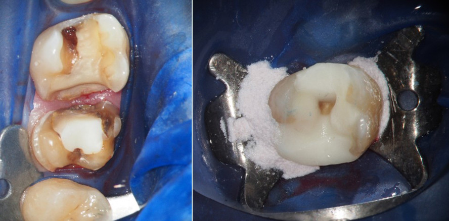 Die Bedeutung der präendodontischen Phase bei der Wurzelkanalbehandlung