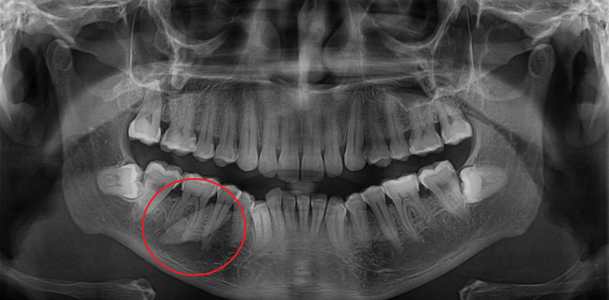 Enttarnt: Vermeintlicher Zahn entpuppt sich als Speichelstein