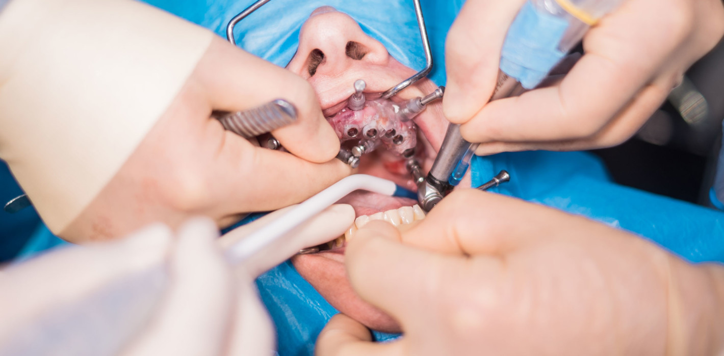 Nach missglückter Zahn-OP Dentalinstrument im Darm