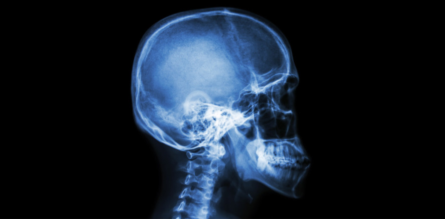 Nach Eishockey-Match: Zahn in Unterlippe gefunden