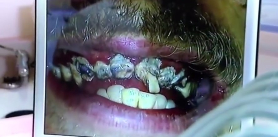 Verfaultes Gebiss: Brite putzt sich 20 Jahre lang nicht die Zähne