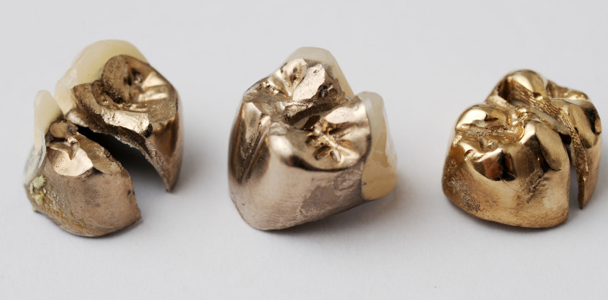 Zahngold: Lukrativ für Schweizer Krematorien