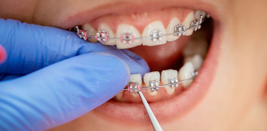 Metallstück einer Zahnspange bringt Jugendliche in Lebensgefahr