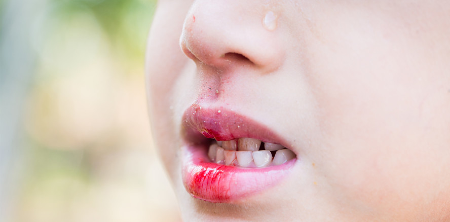 Schweizer Kinder erleiden häufiger Zahnunfälle mit bleibenden Zähnen