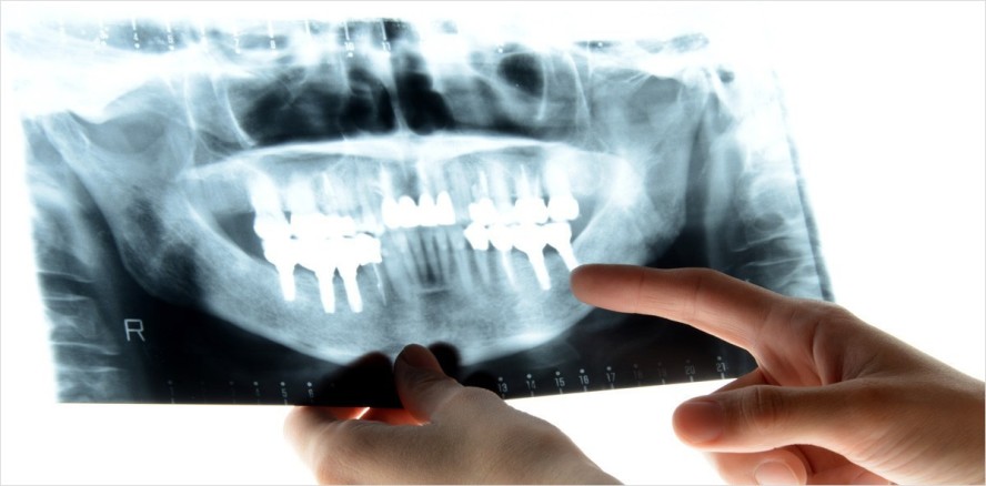 Zementierte Restaurationen begünstigen Periimplantitis