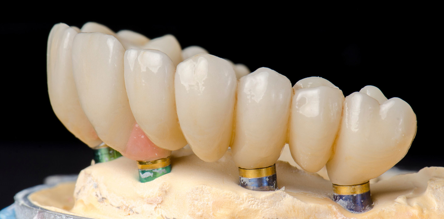 Restaurationen aus Zirkoniumdioxid als Langzeitversorgungen ideal