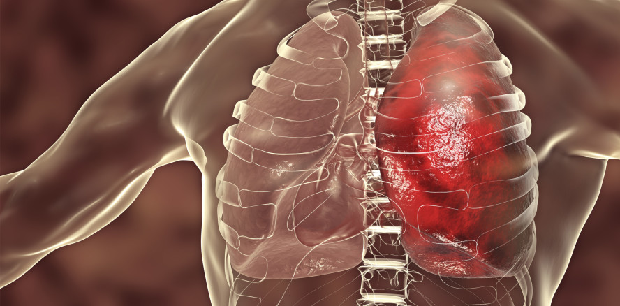 Lungenentzündung: Welchen Einfluss hat das Zungenmikrobiom?