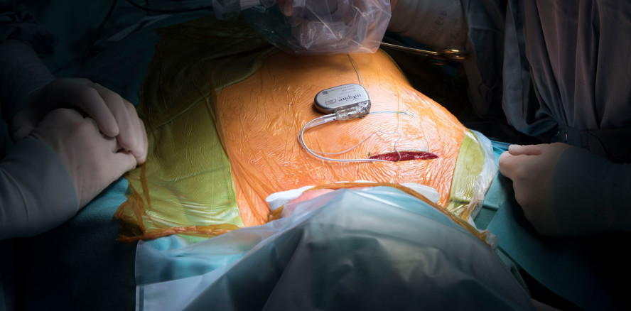 Erster Zungenschrittmacher implantiert, der MRTs ermöglicht