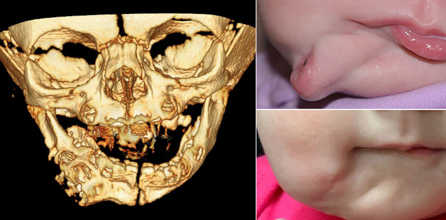 Seltenes Phänomen: Baby mit zwei Mündern geboren