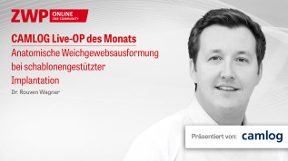 Live-OP Anatomische Weichgewebsausformung bei schablonengestützter Implantation