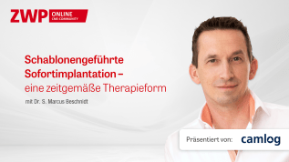 Schablonengeführte Sofortimplantation – eine zeitgemäße Therapieform