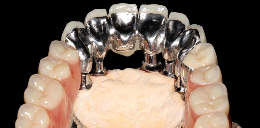 NEM-Fräsrohling für herausnehmbaren Zahnersatz in der Anwendung