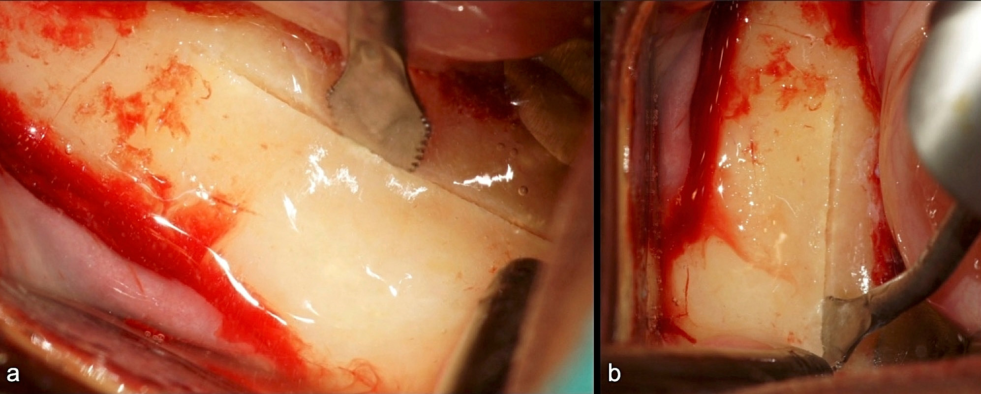 Abb. 1: Spenderareal: Osteotomie-Winkel mit Piezosäge (B6 von W&H) zur Abgrenzung des Knochenblocks (a, b).