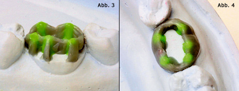 Modellation einer Vollgusskrone