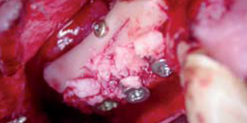 Block- und Knochenaugmentationen