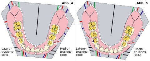 Okklusionskonzepte in der Totalprothetik