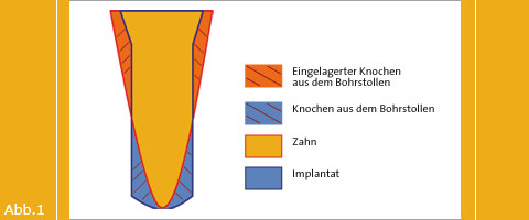 Minimalinvasive Insertion von Zirkonoxidimplantaten