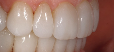 Die Vielseitigkeit von Lithium-Disilikat